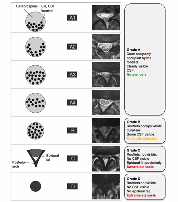 Osteoporosis Prediction